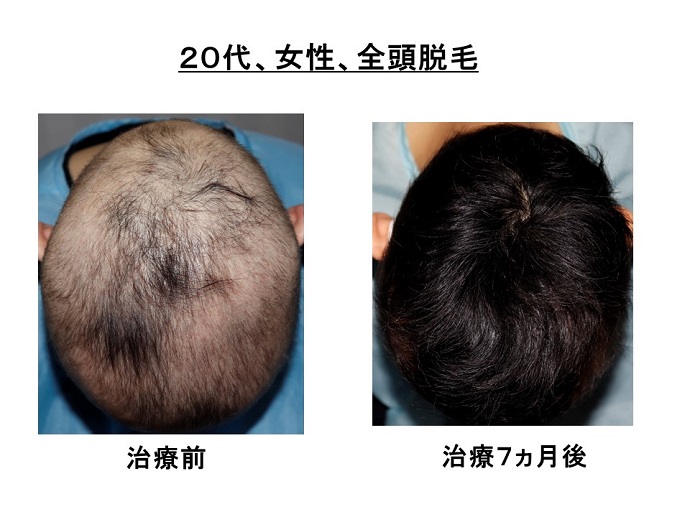 円形脱毛症　病院